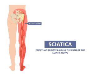 Sciatic Nerve Chiropractor - Chiropractor Conyers AICA