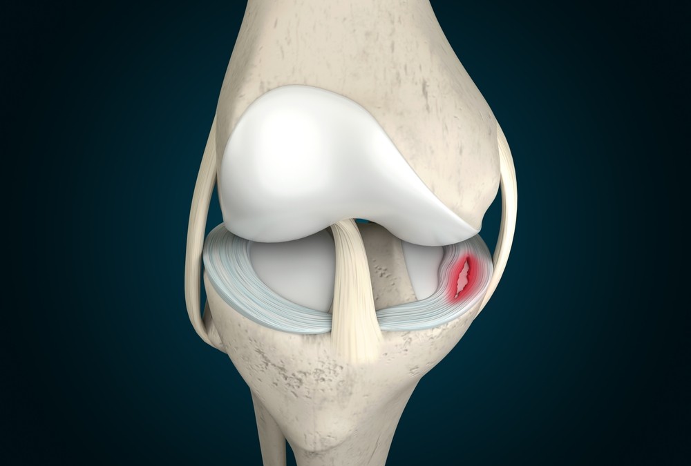 Factors in Recovery from Meniscal Tear Surgery
