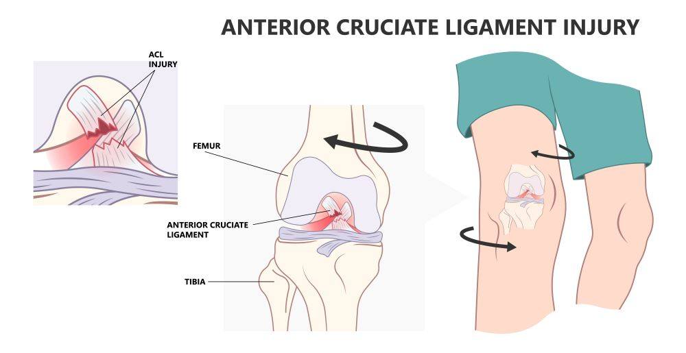 What Happens with ACL Surgery